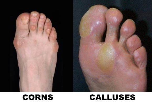 How To Heal A Callus On Your Toe