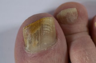 Fungal nail infections - Dr7 Physiotherapy Podiatry Hydrotherapy Massage